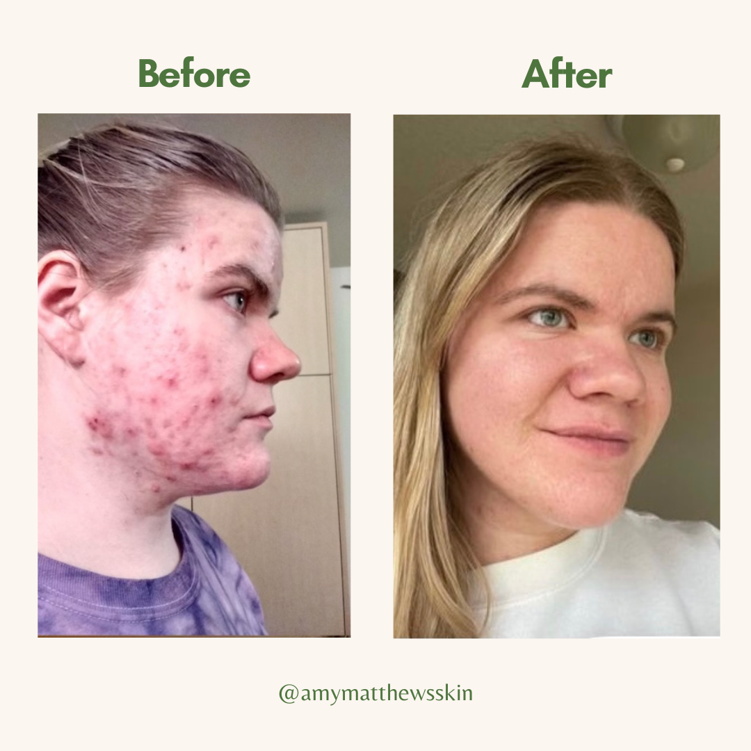 CLARIFYING TEA TREE FACE OIL
