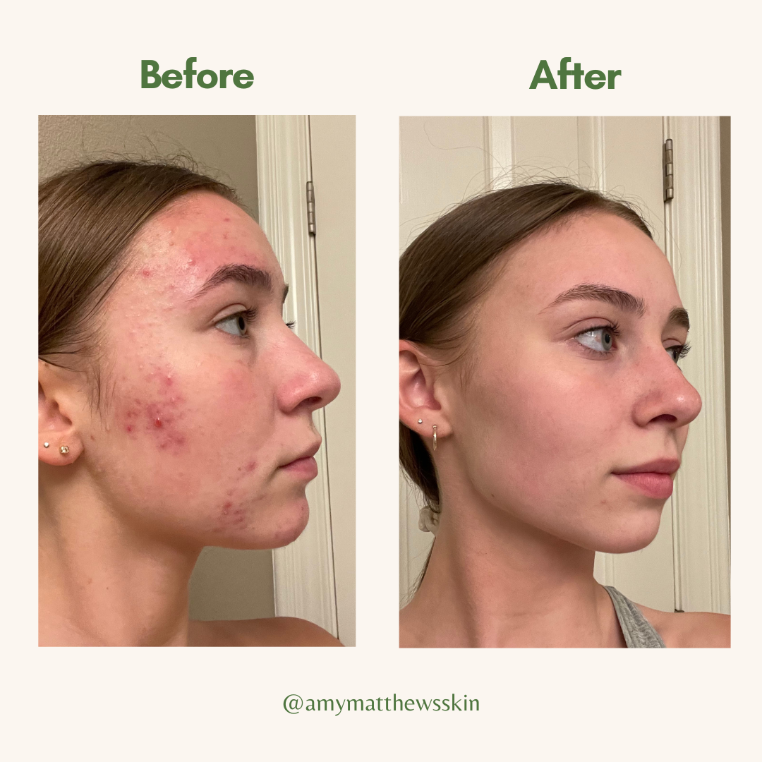 CLARIFYING TEA TREE FACE OIL